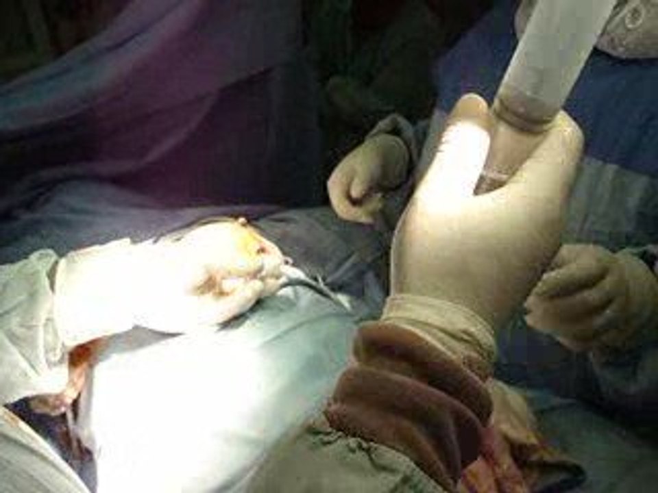 تجميل الثدي,تكبير الثدي,شد الصدر.نحت,رفع الصدر,حقن السليكون,