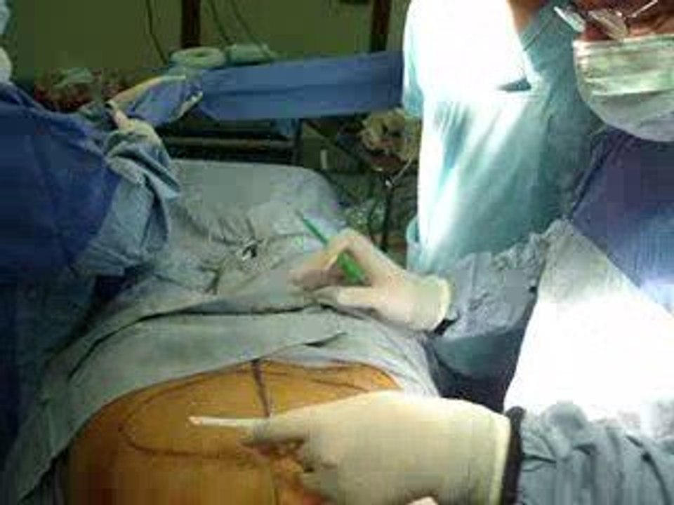 نحت البطن,الخصر,الارداف,الخلفية,قطر,دبي,العراق,شفط الدهون,