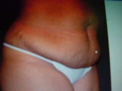 شفط الدهون والشحوم,ازالة الشحوم,نحت الارداف,دبي,قطر,العراق