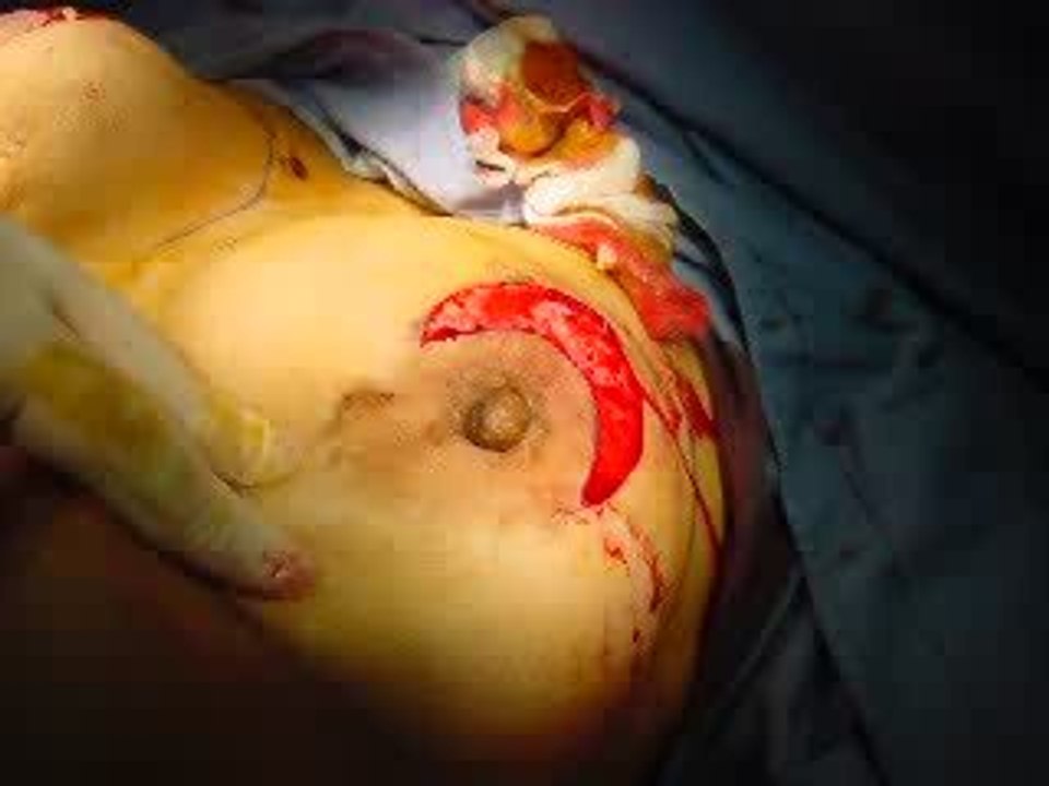 تكبير الثدي,شد الثدي.قطر,دبي,العراق,تجميل الصدر,عملية تجميل,