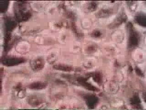 Les effets néfastes du Fluor