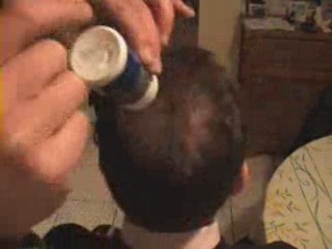 Calvitie, alopécie combatez les signes de l'age HAIR REBIRTH