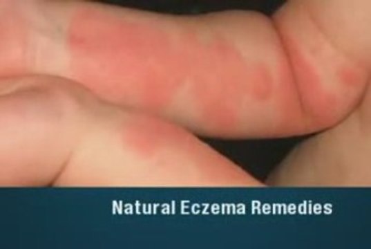 Natural Eczema Remedies
