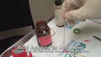 Ingrown Toenail Surgery