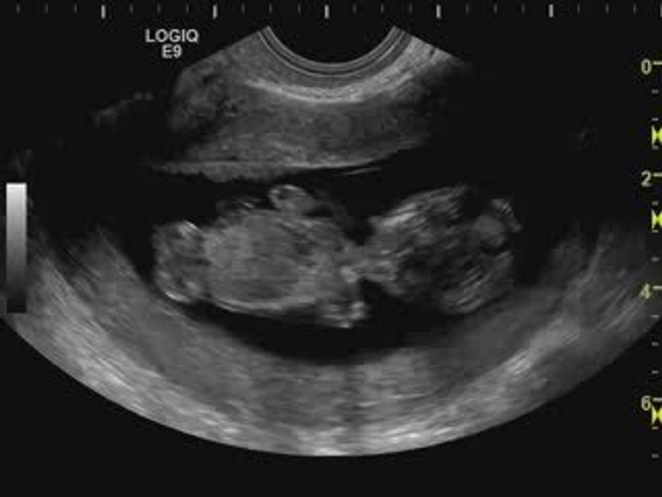 bébé se retourne echo 12 SA