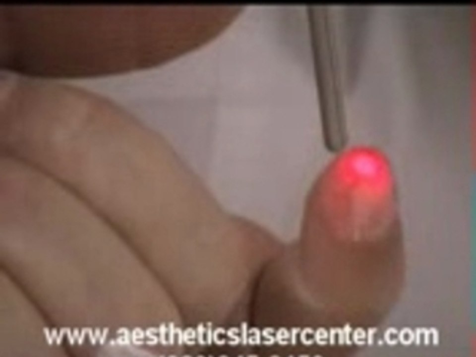 Laser Skin Treatments Tawas Michigan