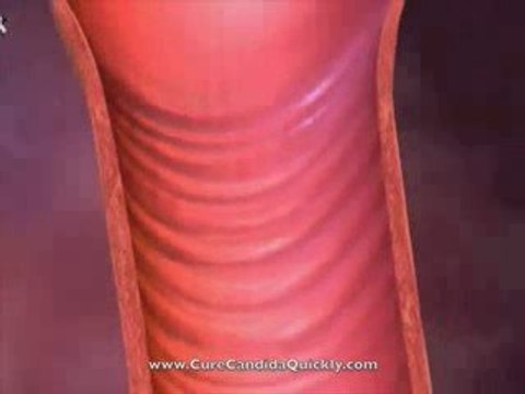 Cure Candida Yeast Infections