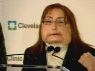 US face transplant patient faces the media