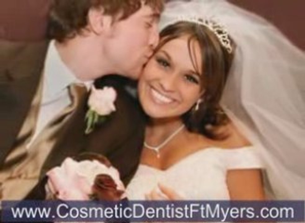 Veneers Ft Myers, Veneers Naples, Veneers Cape Coral