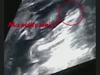 FILM échographie du 11 mai 2009