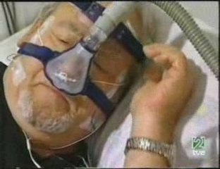 SAOS: Sindrome de la apnea obstructiva del sueño