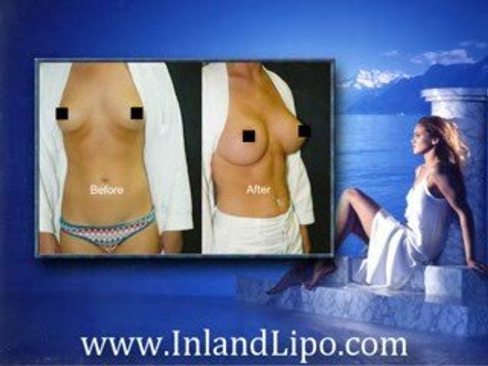 Breast Implants Riverside - Riverside Breast Augmentation
