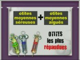 LA MINUTE DE LA SANTE - L'otite