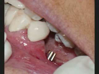 Dental implants India Dentist in India
