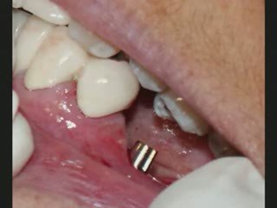 Dental implants India Dentist in India