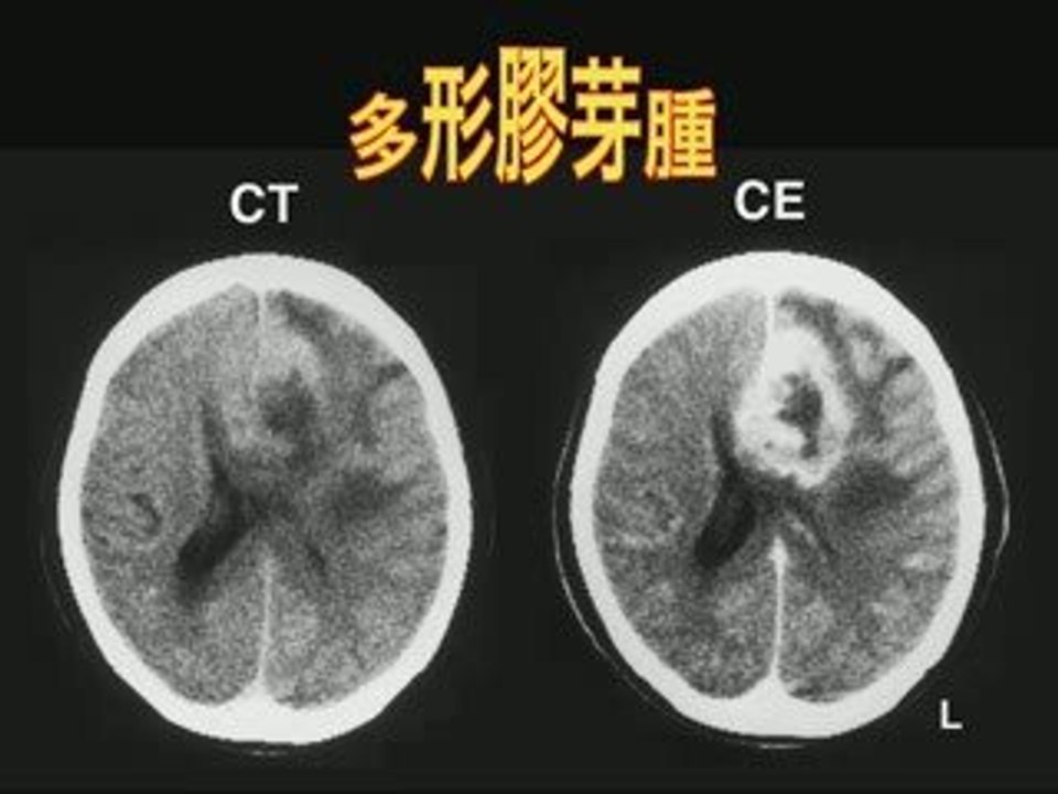 Head CT and MRI