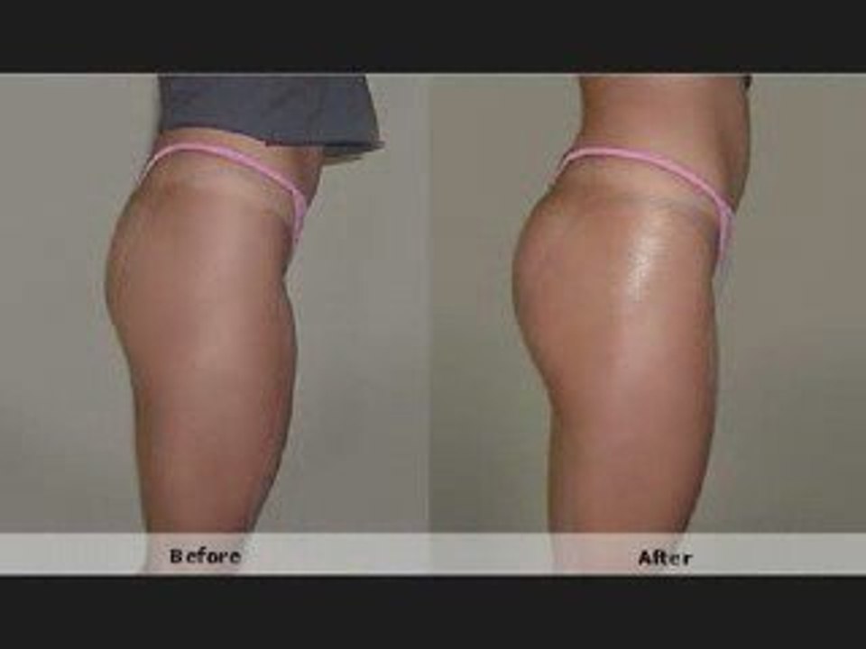 Butt Plastic Surgery Injections NOT Butt Implants