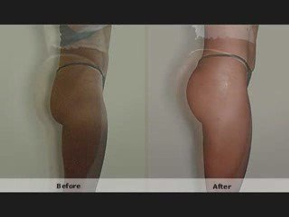 Butt Augmentation + Injectable Implants