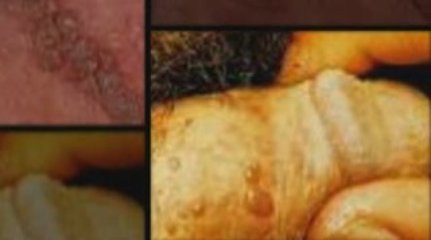 If You Need A Wart Remover, Watch This!