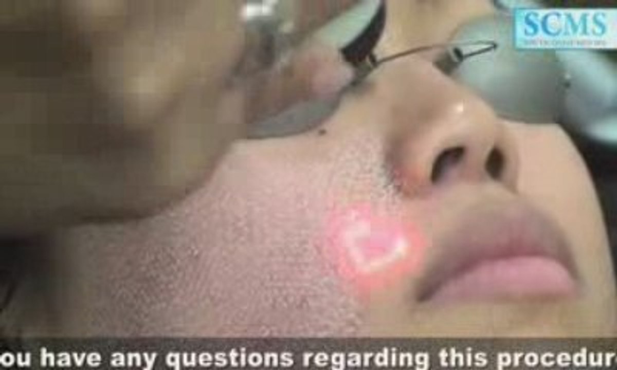 Laser Acne Removal