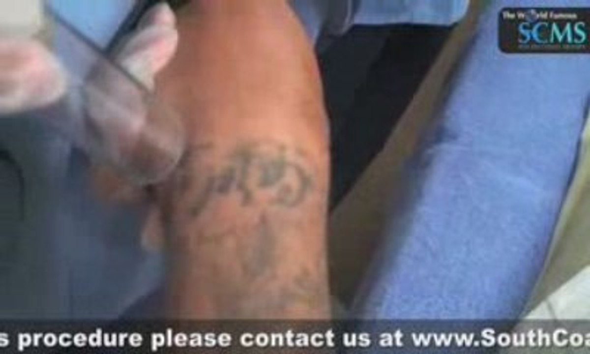 Laser Tattoo Removal Arm