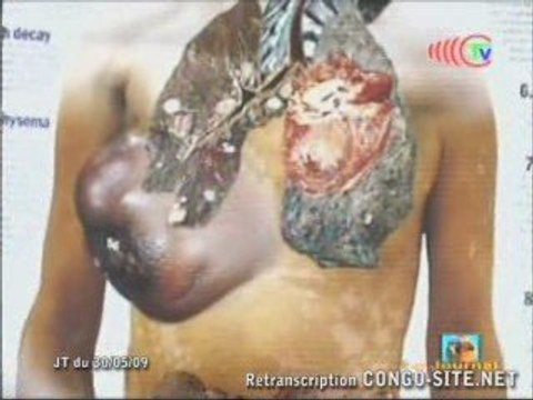 La journée mondiale sans tabac, message de l’OMS Afrique