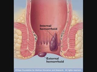 What are Hemorrhoids or Piles?