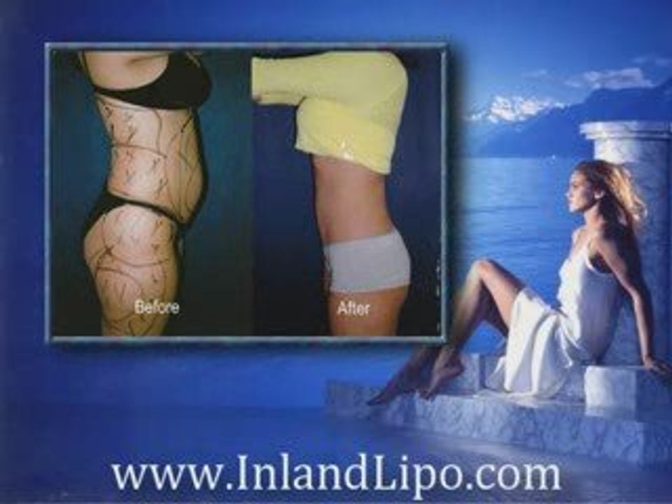 Riverside Liposuction - www.InlandLipo.com