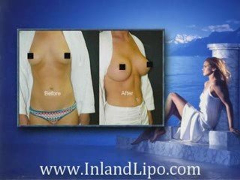 Murrieta Breast Augmentation - Breast Implants Murrieta
