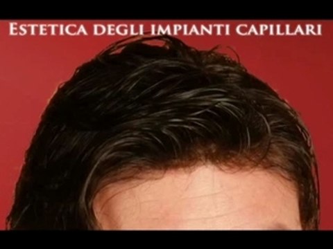 Trapianto dei capelli, visita il sito luigiuomo.com