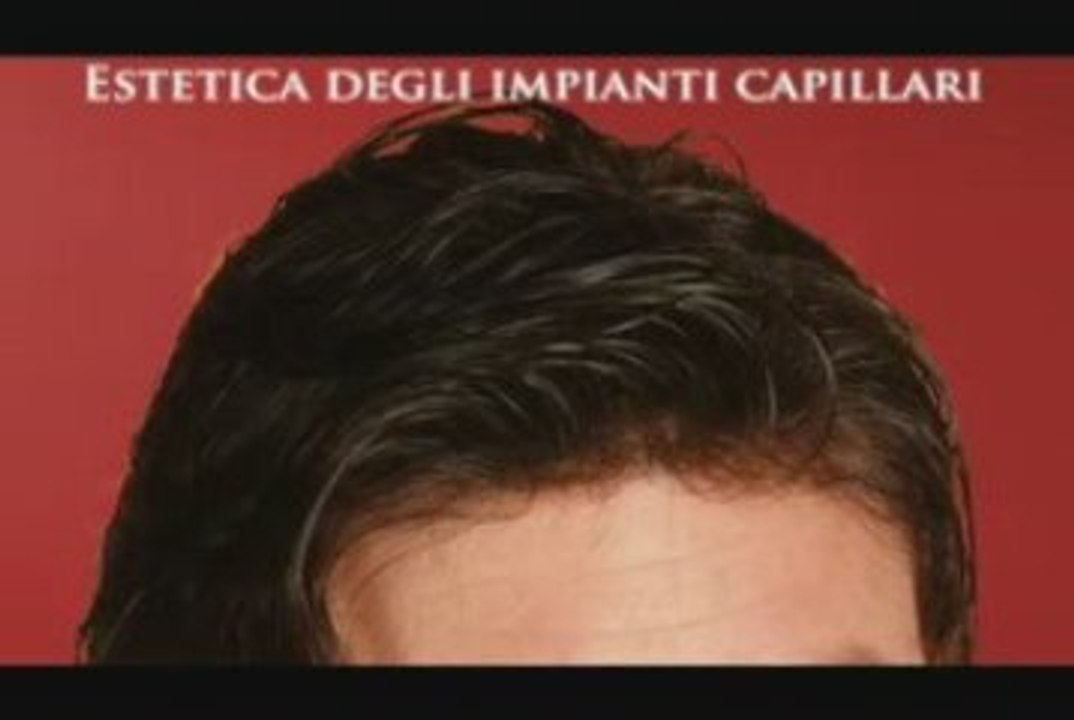 Impianti capelli, visita il sito www.luigiuomo.com