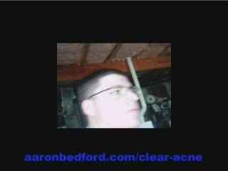 Acne Free in 3 Days is Giving Me a Zit Free Life