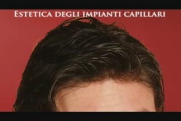 Calvizie : curare calvizie e caduta di capelli