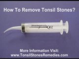 Removing Tonsil Stones