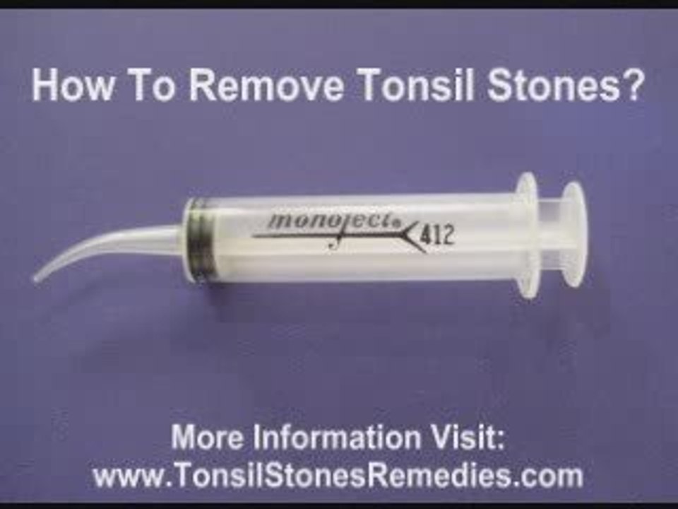 Tonsil Stones Removal