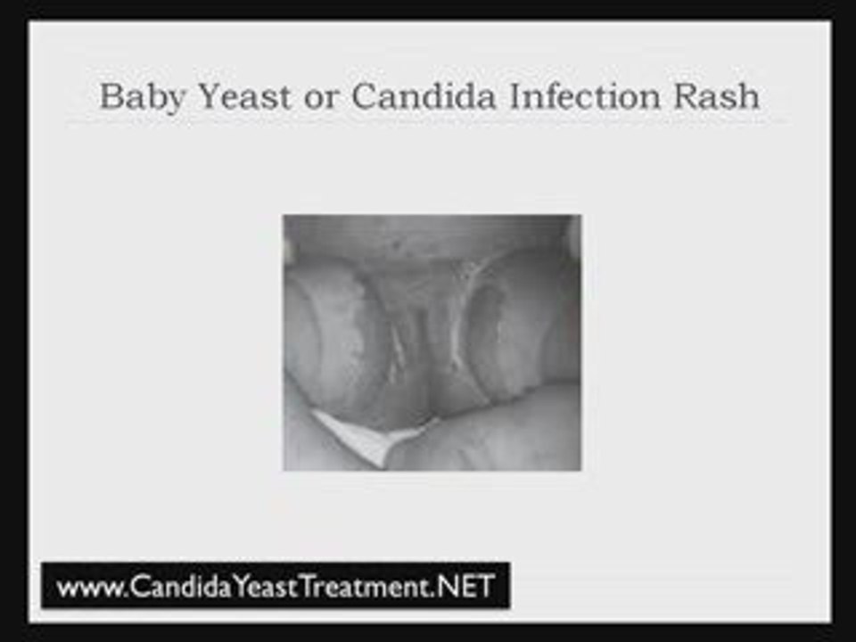 Yeast Infection Picture