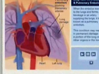 DVT Deep Venous Thrombosis
