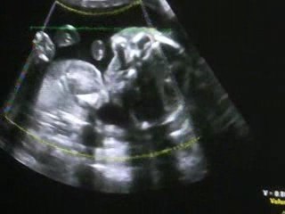 Echographie du 8 juin 2009