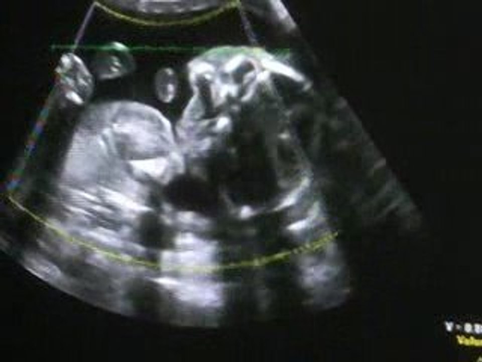 Echographie du 8 juin 2009