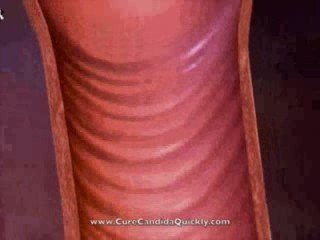 Vaginal Thrush Treatment