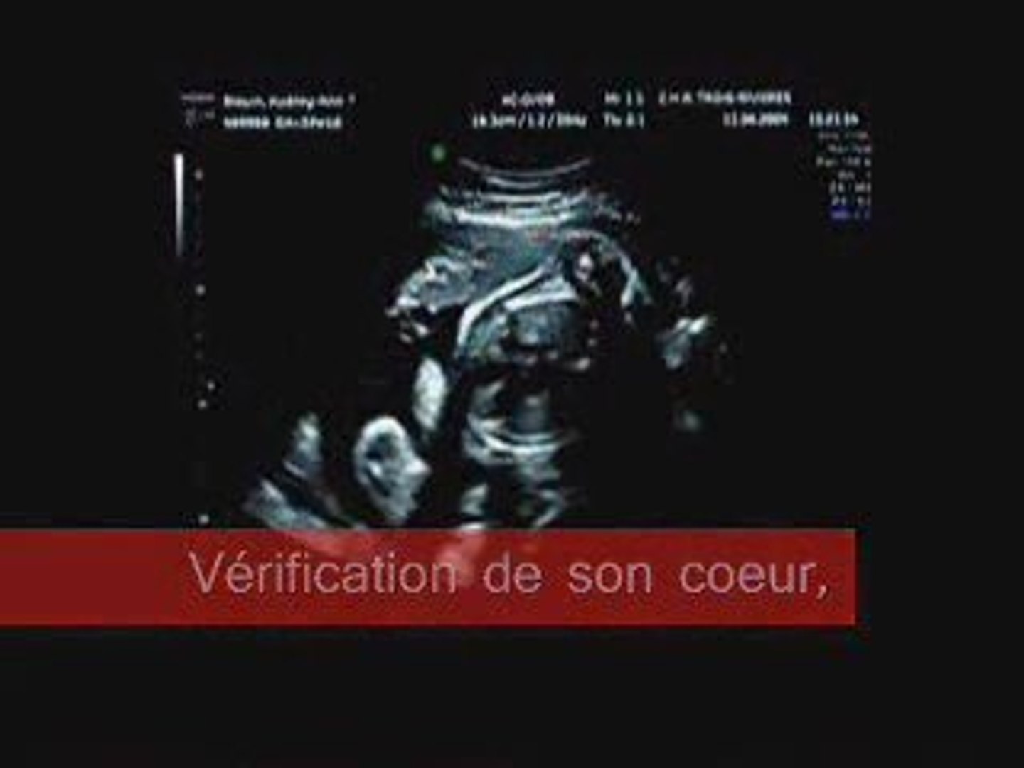 Echographie Obstetricale 32 Semaines Video Dailymotion