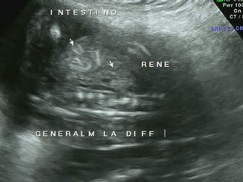 Intestino iperecogeno
