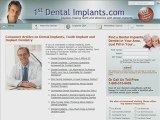 Locate a Dental Implants Dentist for Implant Dentistry