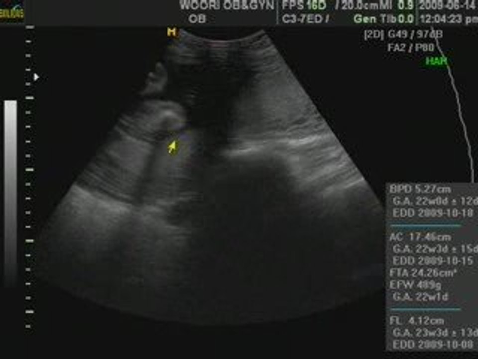 yuna on her 23 weeks..