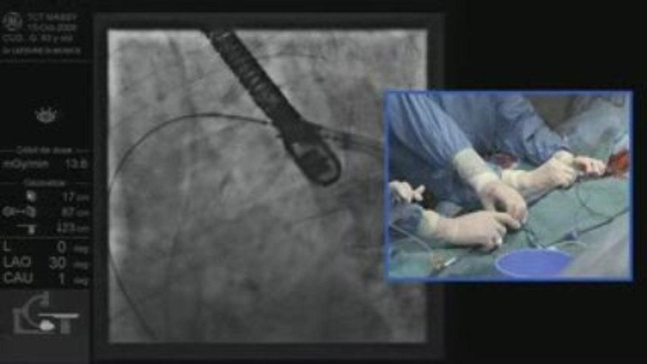 Pose d'une valve aortique - Exemple 2, partie 2