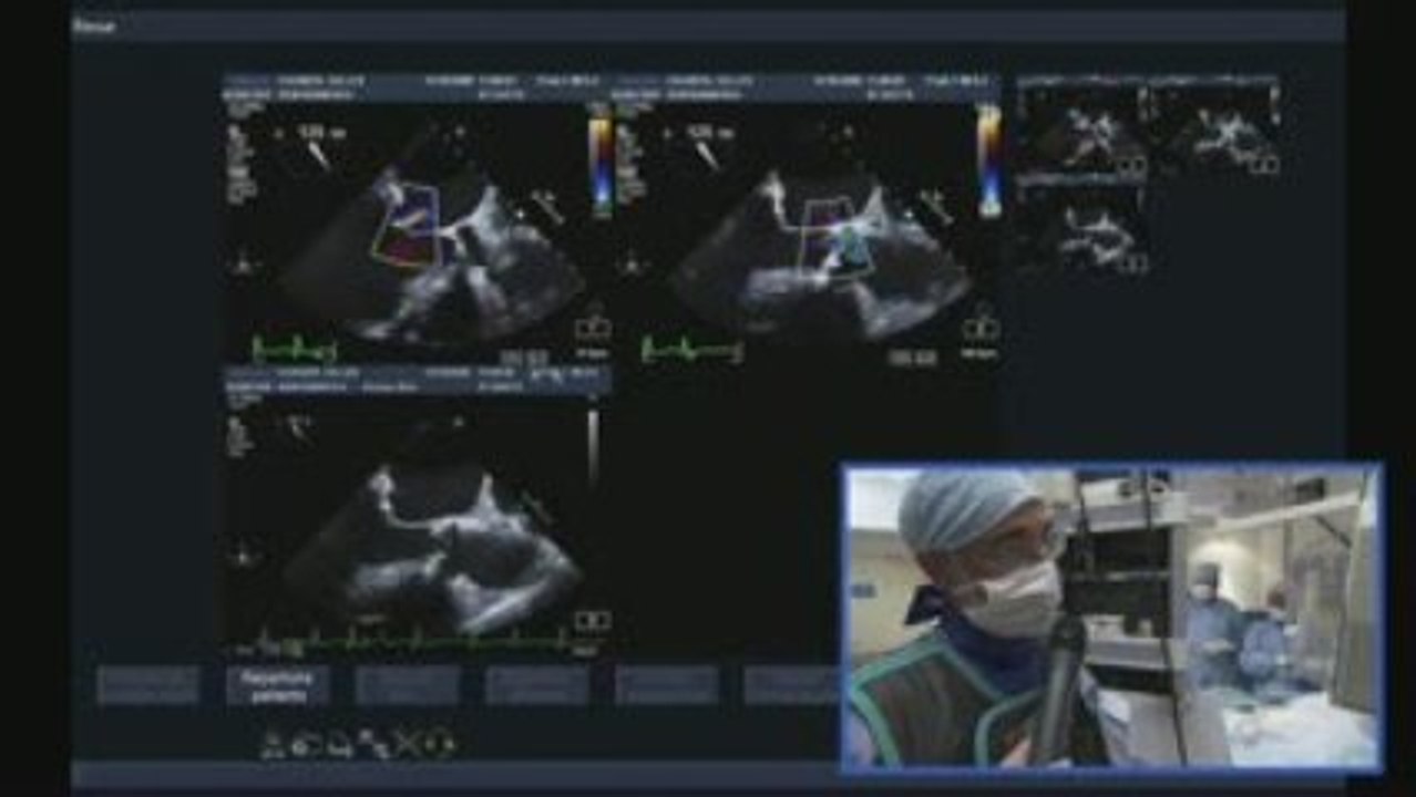 Pose d'une valve aortique - Exemple 2, partie 1