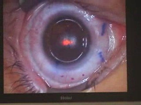 Laser myopie du Docteur Chemla au Centre Vision Laser 92