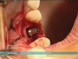 implants dentaires operation prothese