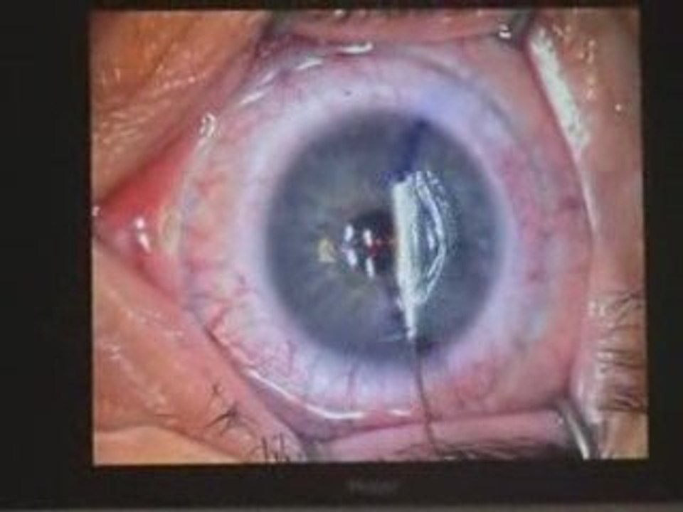 Opération laser de myopie Dr Chemla Centre Vision Laser